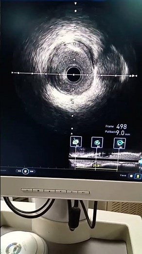 Intravascular ultrasound (IVUS)