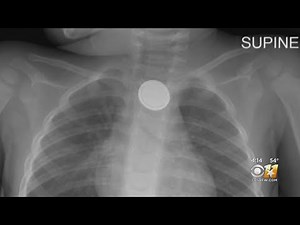 Look Out For Child Choking Hazards