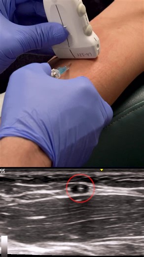BioReset Medical on Instagram: "Using ultrasound guidance to start an IV allows for greater accuracy, efficiency, and patient comfort. In this video, @mattcookmd walks through the step-by-step process while performing the procedure in real time. #regenerativemedicine #precisionmedicine #biomed #painreliever #injection"