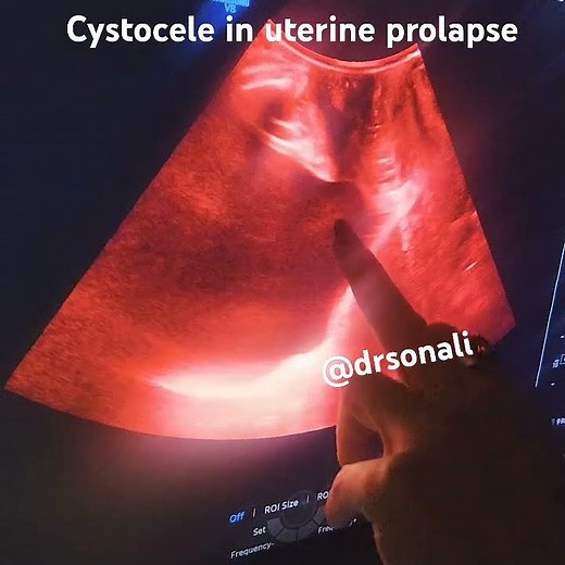 Cystocele demo on tvs in patient of uterine prolapse