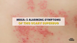4K views · 16 reactions | MRSA is a superbug that causes swelling and irritation of the skin. It's a bacteria that resists most of the antibiotics out there. Here's what you need to know. #health #healthtip Read more>> bit.ly/3V1Fsug | LittleThings | Facebook