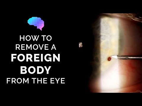 How to Remove a Foreign Body from the Eye | Eye Injury | OSCE Guide | UKMLA | CPSA | PLAB 2