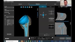 Proximal Humerus Nonunion: Step-by-Step Pre-Op Planning for Reverse Shoulder Arthroplasty