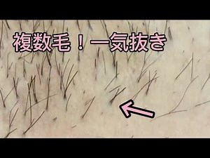 【複数毛】１つの毛穴から３本。一気抜き