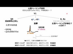 【心電図】心電図Survey2022年振返り Q８ペーシング部位の同定について まめたろう先生の解説