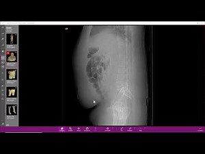 Intestinal infarction