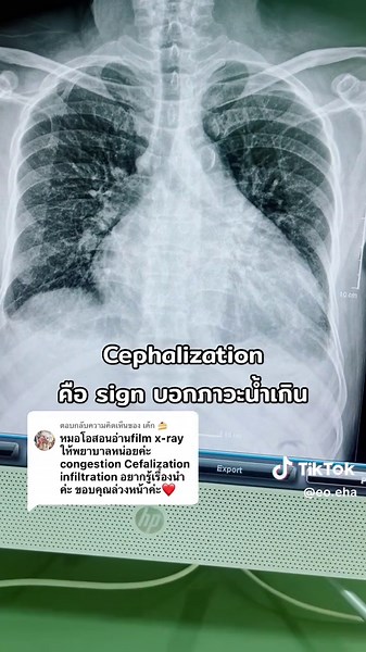 ตอบกลับ @เค้ก 🍰 #cephalization #น้ำเกิน #หัวใจวาย #congestiveheartfailure #ความรู้ #อ่านฟิล์ม