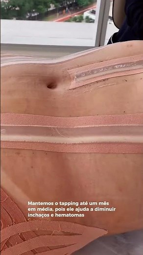 Como é o Pós-Operatório de uma LIPO HD (cirurgia) #cirurgiaplastica