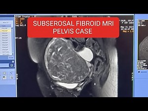 Mri pelvis subserosal fibroid case @Mri pelvis Fibroid case