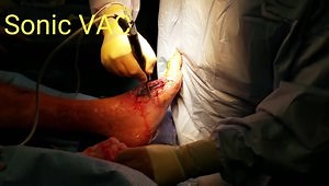 Ultrasonic Wound Debridement