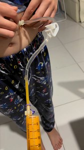 2.2K views · 113 reactions | #mickeybutton #gtube #feedingtubeawareness vitamins and probiotics all the yum yums | Zackary's Treacher Collins Syndrome Journey | Facebook