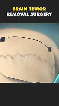 Brain Tumor Removal Surgery (3D Animation) #craniotomy #craniectomy #craniotomysurvivor #braintumor