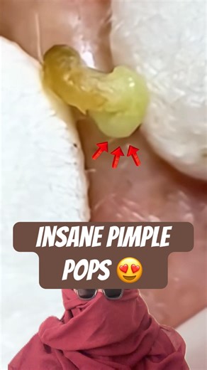 Pimple Popping Compilation 😩 #blackheads #pimplepopping #skincare #shorts #viral #reaction #acne