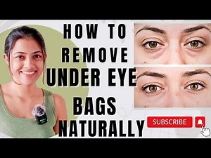 HOW TO REMOVE UNDER EYE BAGS NATURALLY | WHAT CAUSES UNDEREYE BAGS |HOW TO GET RID OF UNDEREYE BAGS