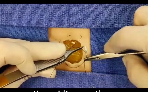 荷包缝合（Purse-string Suture）