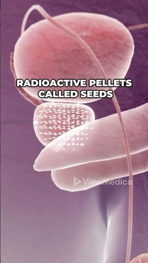 Radioactive Prostate Seeds (3D Animation)