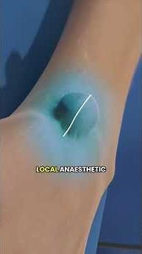 Ganglion Cyst Removal Explained 🔍 | #orthopedics #medicalshorts #handurgery