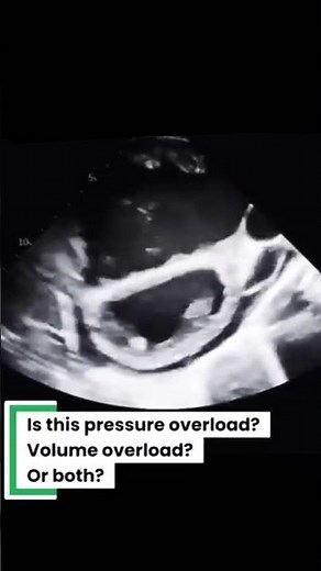 Dilated both atrium and right ventricle Calcified mitral valve with MS And large ostium secondom ASD