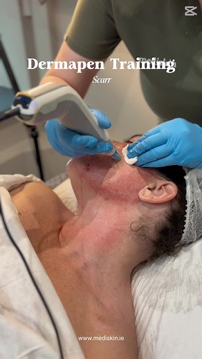 Scar Training with Dermapen ✨Dermapen 4 & Uber MD Peel Medical grade peel that was specifically formulated to address scars, stretch marks and stubborn pigmentation #dermapen#dermapen4#microneedling#Mediskin#nenagh
