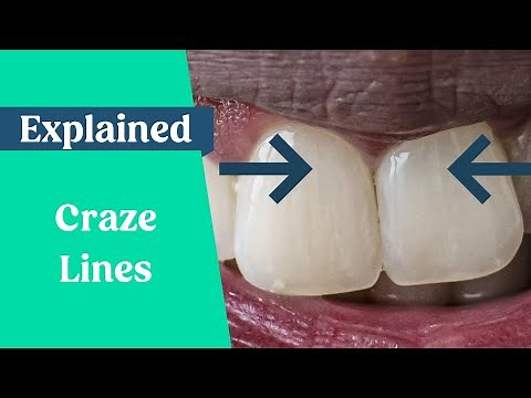 What are craze lines?