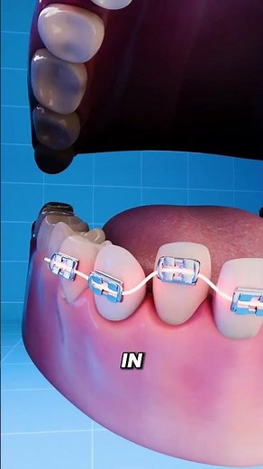 Here's How Braces Work