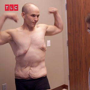 635K views · 11K reactions | He worked hard to lose 300lbs… But his excess skin hides his true progress ️‍♀️ #MyExtremeExcessSkin | TLC UK | Facebook