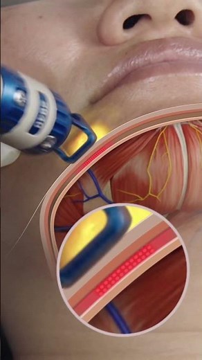 ClearLift Laser Facial Experience ✨