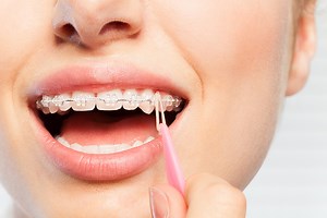 Malocclusion of Teeth and How Elastic Bands Help Correct it