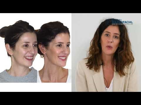 Bimaxillary Surgery Case #183-Soraya: Class II, Mandibular hypoplasia, Maxillo-mandibular Retrusion,