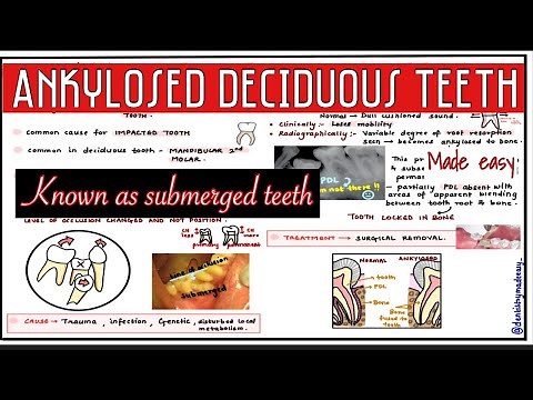 ANKYLOSED DECIDUOUS TEETH || SUBMERGED TEETH || Oral pathology