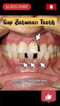 Gap between teeth| don't ignore it!