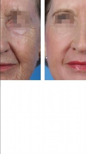 Erbium: YAG laser skin resurfacing