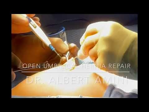 Open Umbilical Hernia Repair