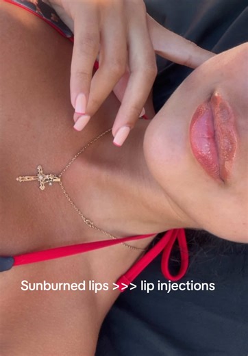Beach Vibes: Natural Beauty of Sunburned Lips