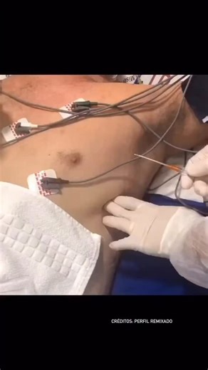 El Estudiante de Enfermería on Instagram: "La toracocentesis es un procedimiento mínimamente invasivo que introduce una aguja hueca en el espacio pleural (entre pulmón y pared torácica) para extraer líquido o aire con fines diagnósticos (analizar el líquido) o terapéuticos (aliviar falta de aire). A diferencia, la toracotomía es una cirugía abierta más invasiva, que implica una incisión en la pared torácica para acceder directamente a los pulmones y estructuras torácicas, usándose para problemas