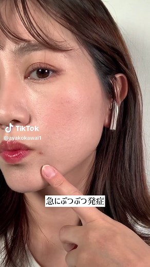 【ニキビだと思ったら脂漏性皮膚炎だった話】#脂漏性皮膚炎 #ニキビ #ニキビ改善 #吹き出物