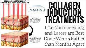 How to get the Best Microneedling Results