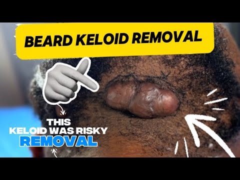This Keloid was risky removal. Did you know what causes beard keloids