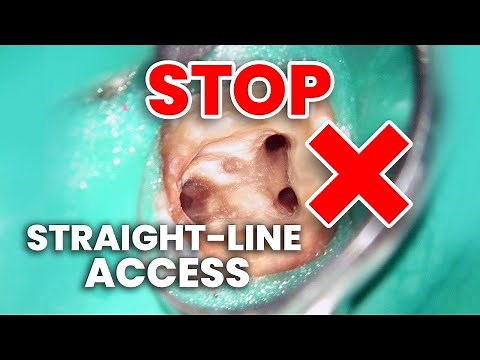 Why Orifice Directed Access Beats Straight-Line in Root Canals
