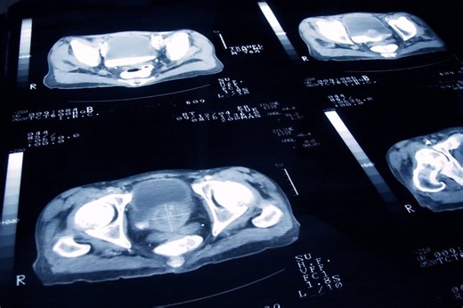 Here’s what actually happens in a prostate cancer screening