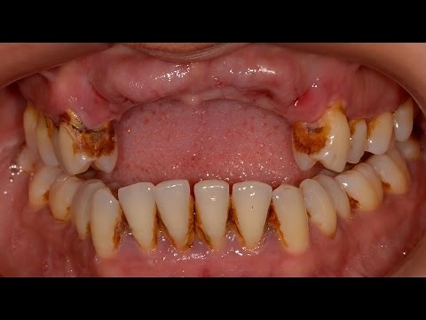 Tooth Loss due to Periodontal (Gum) Disease.