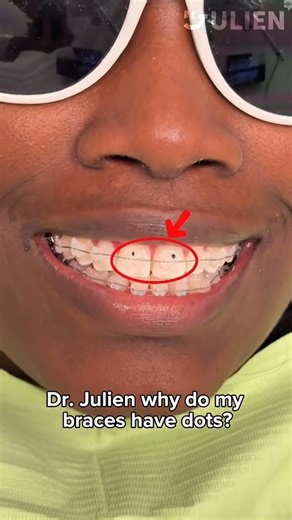 Dr. Julien 닥터줄리엔 | 🔍 What Are the Dots on Braces Brackets? Those tiny dots on your brackets are intentional — they help orthodontists place each bracket... | Instagram