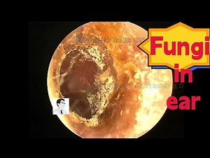 Ear wax removing,Ear fungal dry pieces cleaning processing,12mins,20221117