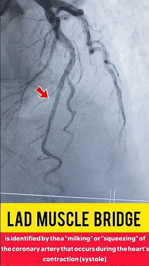 LAD muscle bridge in Coronary angiography