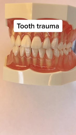 Tooth Trauma and Avulsion Explained for Parents