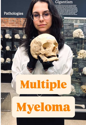 Understanding Multiple Myeloma and Its Impact on Bone Health