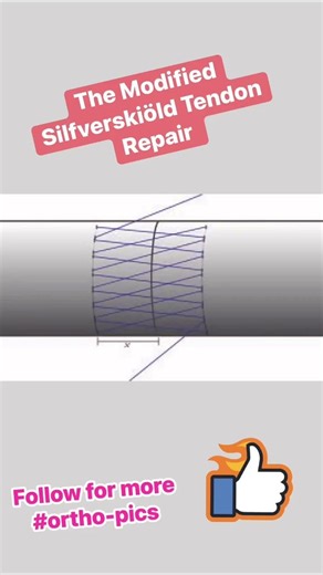 The Modified Silfverskiöld Tendon