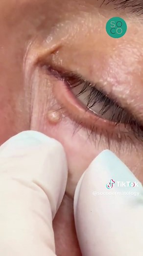 A small lower eyelid milia, treated with precision and care 👁️✨ Dr. Evans performed a gentle extraction with minimal disruption, leaving the skin smooth and the patient feeling immediate relief. Even the smallest concerns deserve expert attention. #SoCoDermatology #MiliaExtraction #EyelidCare #DermatologyExperts #ClearSkin