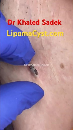 Massive blackhead extraction Dr Khaled Sadek #blackheadremoval #blackheads #skincare