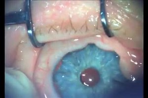 #Artificial eye iris implantation surgery... | Medical Talks
